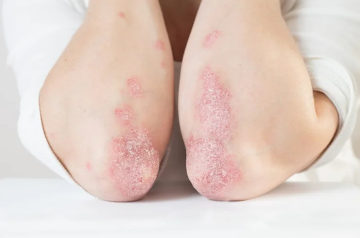 Psoriasis-----2